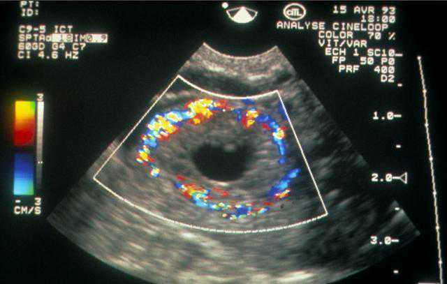 三代试管介绍,卵巢早衰可以做美国试管婴儿吗？
