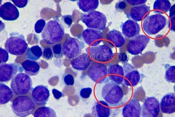 三代试管代怀保密咨询,急性早幼粒细胞白血病是一种血癌,急性早幼粒细胞白血